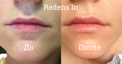 Redens'in - натуральное средство для увеличения губ Redens'in - натуральное средство для увеличения губ